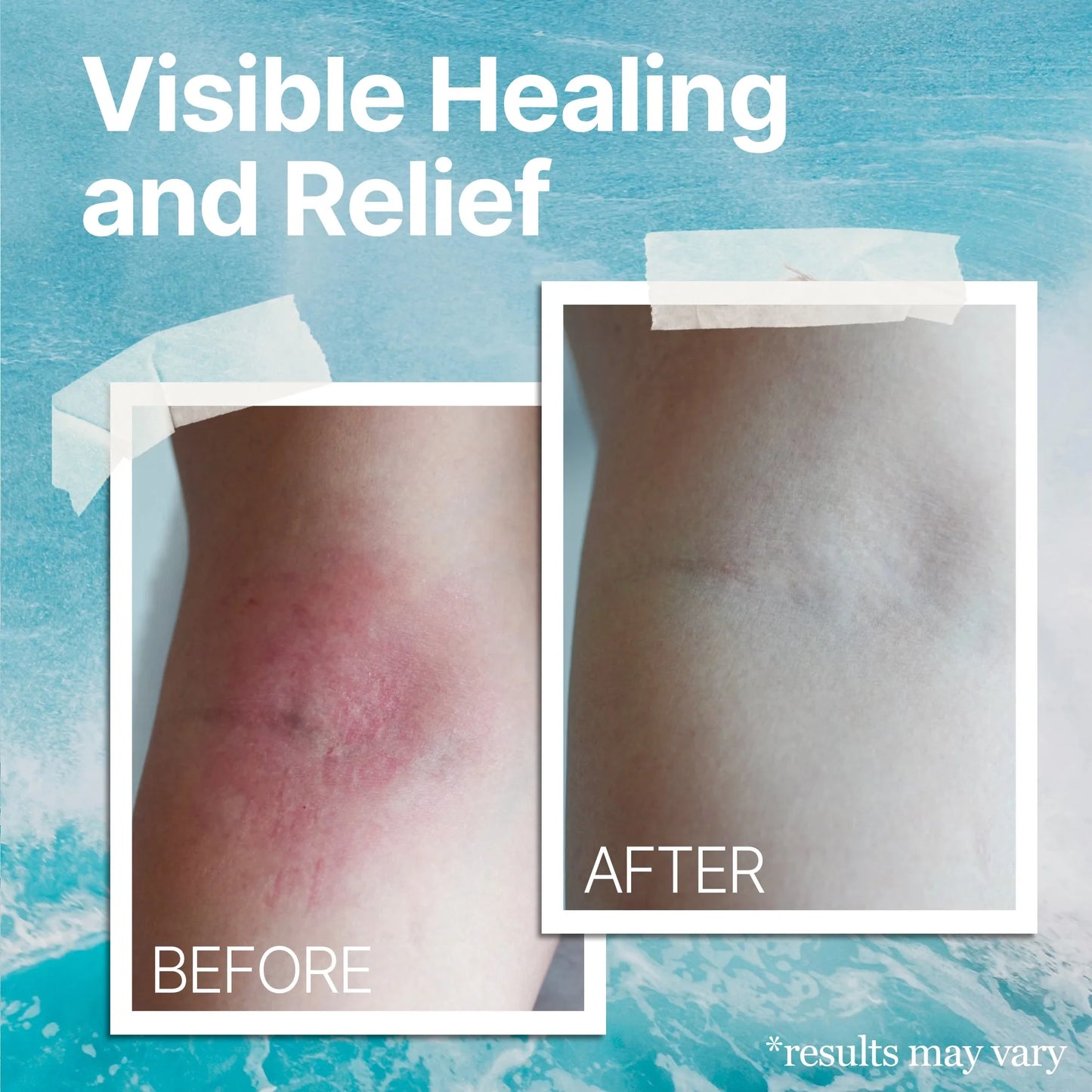 CoraLane™ EczEase - Soothing Cream